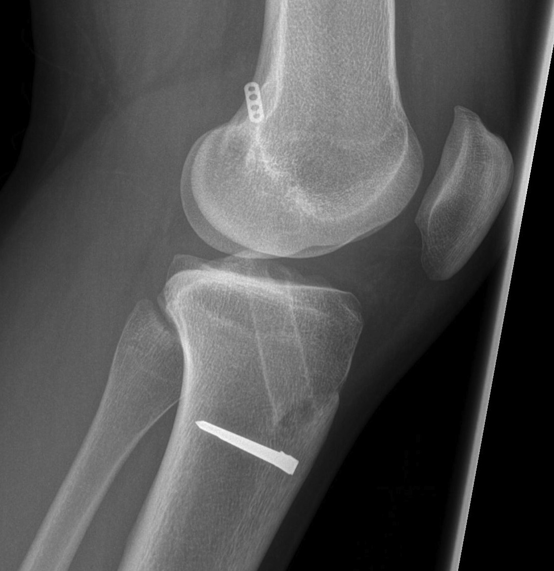 Failed ACL Posterior tibial tunnel